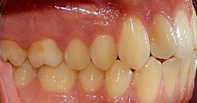 Fig.4 Intraoral lateral derecho