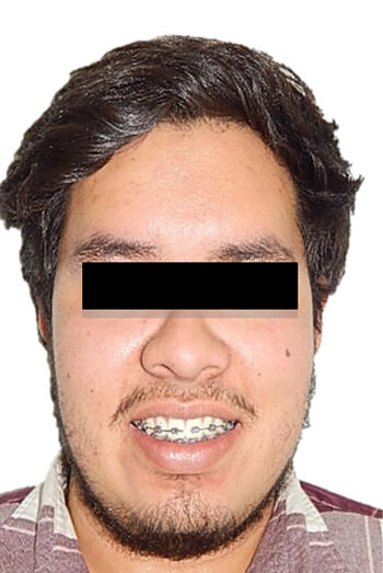 Fig.8 Extraoral de sonrisa