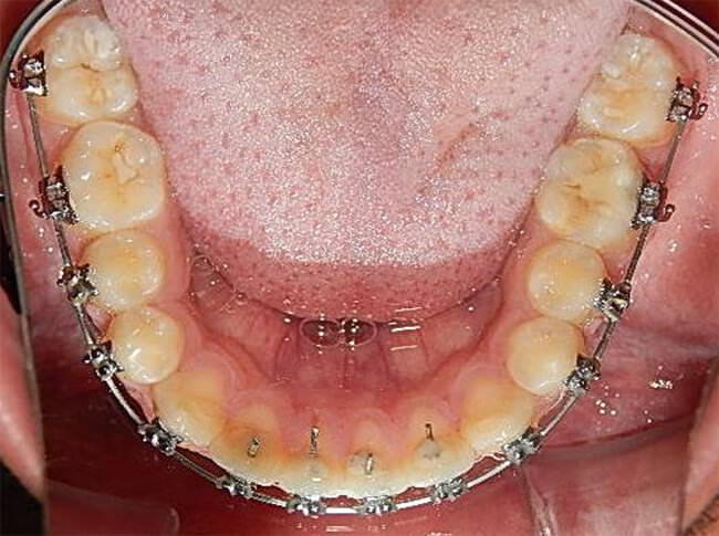 Fig.9 Intraoral oclusal inferior