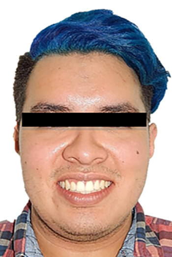 Fig.12 Extraoral frente sonrisa