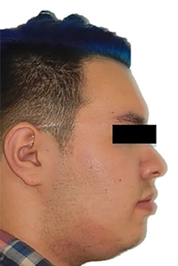Fig.13 Extraoral perfil