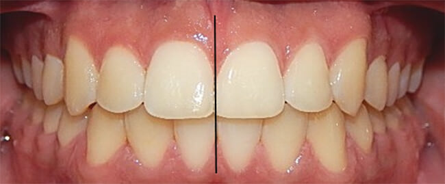 Fig.14 Intraoral frente sonrisa