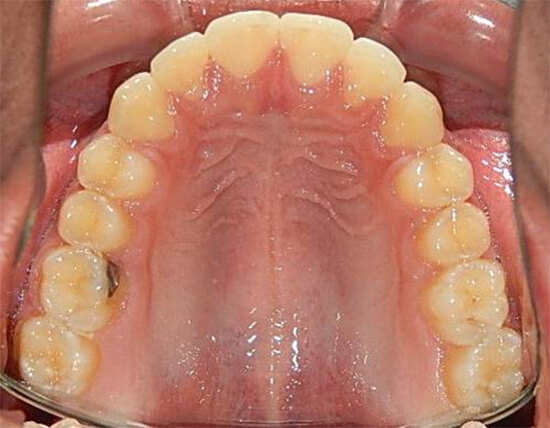 Fig.17 Oclusal superior