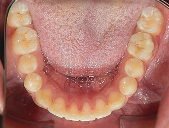 Fig.18 Oclusal inferior
