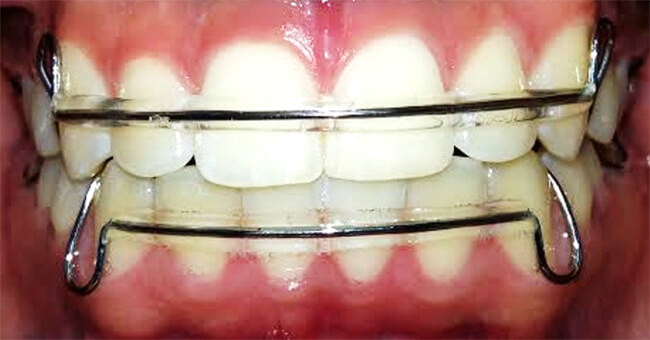 Fig.20 Intraoral de frente con retenedores