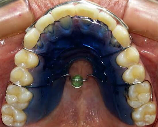 Fig. 21 Vista oclusal perla de tucat
