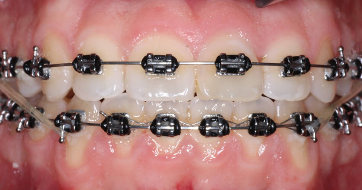 Uso de mini implantes en el shelf mandibular para el tratamiento de maloclusión clase III en paciente biprotruso