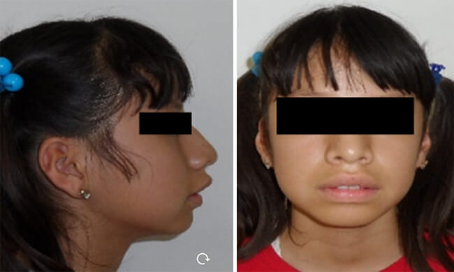 Fig. 2 A. Desequilibrio muscular. Interposición labial, incompetencia labial e hipertonicidad del mentón. B. Facie adenoidea