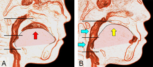 Fig. 5 Postura de la lengua y alargamiento de la vía aérea faríngea después de la ERM. (Tomado de Iwasaki, et al. Improvement of nasal airway ventilation after rapid maxillary expansion evaluated with computational fluid dynamics. Am J Orthod Dentofacial Orthop.2012)