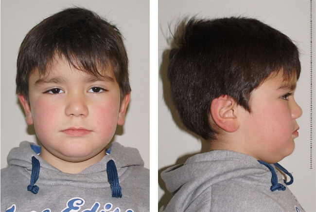 Fig. 1 Fotografías Extraorales de Frente y de Perfil antes de iniciar el tratamiento.