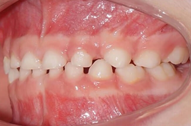 Fig.5 Fotografías intraorales del antes y después del tratamiento.
