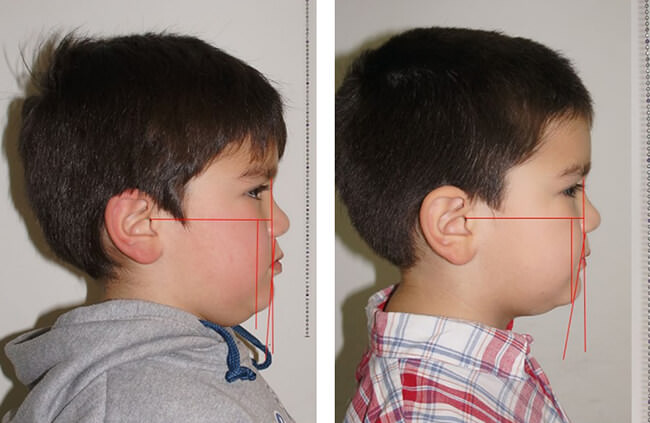 Fig.6 Fotografías extraorales de perfil, antes con un perfil anteinclincado, y después del tratamiento con un perfil retroinclinado (Análisis de Schwartz)