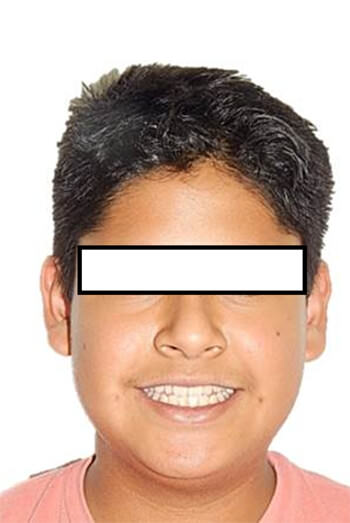 Figura 1 Sonrisa