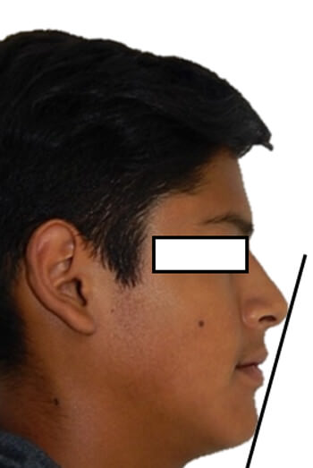 Figura 12 Extraoral de Perfil