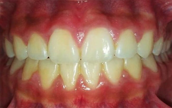 Figura 14 Intraoral frente