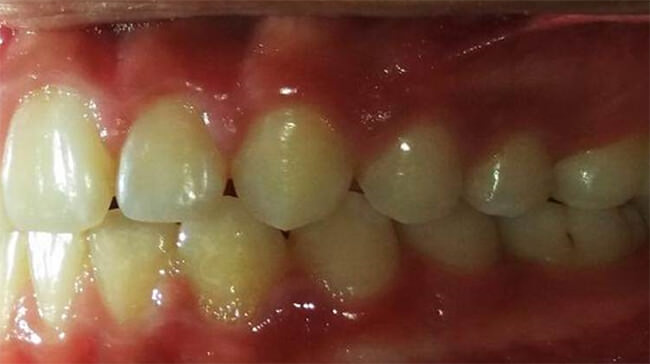 Figura 15 Intraoral izquierda