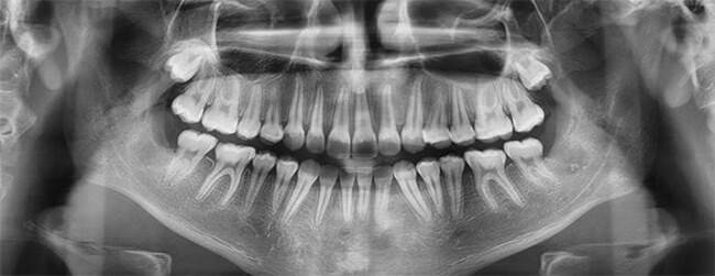 Figura 16 Radiografía panorámica final