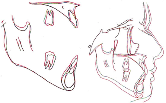 Fig. 20 Sobreimposiciones