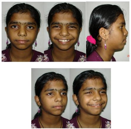Figure 1 Pretreatment Extra oral photographs
