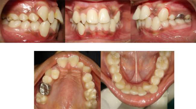 Figure 2 Pretreatment Intra oral photographs