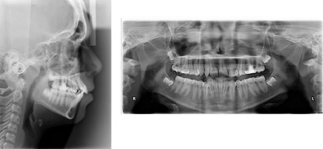 Figure 3 3a Pretreatment Lateral Cephalogram 3b Pretreatment OPG