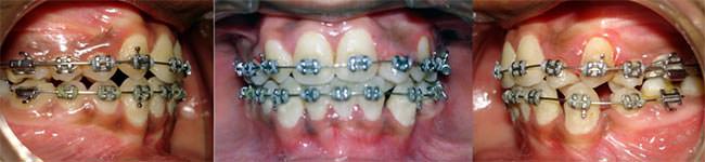 Figure 4 Mid treatmen Intra oral photographs
