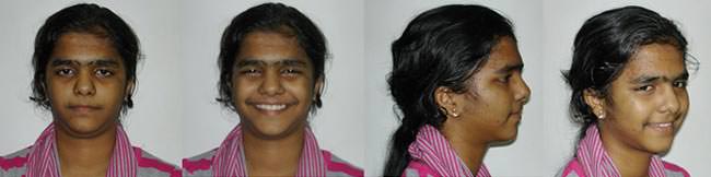 Figure 5 Post treatment Extra Oral photographs