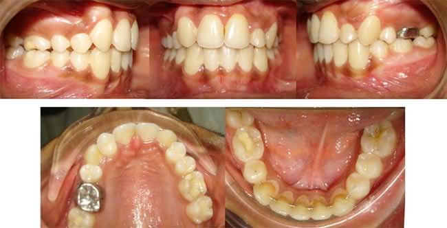 Figure 6 Post treatment Intraoral photographs