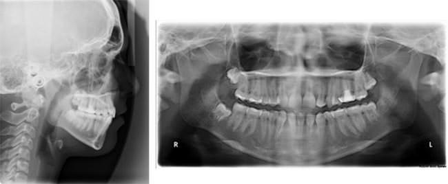 Figure 7 Post treatment Lateral ceph, OPG
