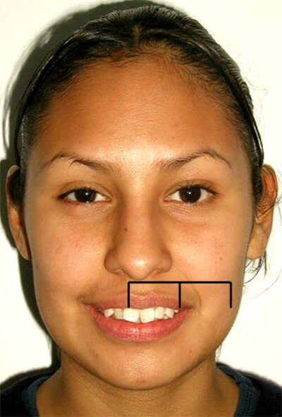 Fig. 2. La longitud del labio superior, las líneas muestras la simetría de elevación del labio superior en el paciente al sonreír, la línea horizontal indica la longitud del labio superior en cual simétrico con la altura de la comisura derecha e izquierda.