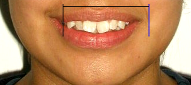 Fig. 3 Se puede observar como se marca en color el arco de la sonrisa.