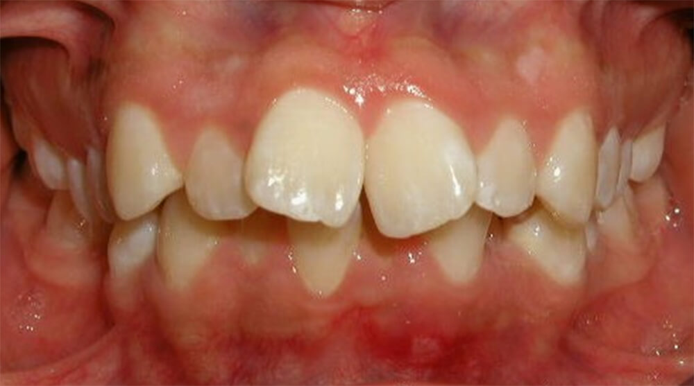 Fig. 4. Observamos como debe ser la simetría de los márgenes gingivales.