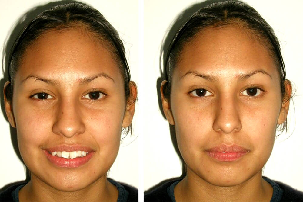Fig. 5. Fotografía de frente en reposo y sonrisa, nótese las características faciales del paciente. Fuente propia del CESO.