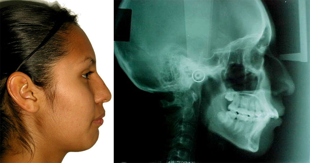 Fig. 6 y 7 En la fotografía de perfil y radiografía lateral de cráneo fig. 7, nótese la clase II esqueletal, hiperdivergente,el ángulo naso-labial y mentolabial. Fuente propia del CESO.
