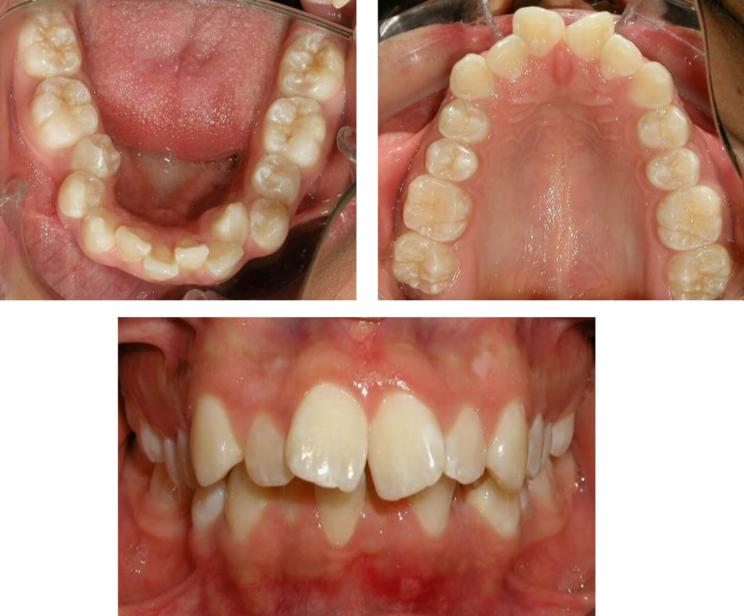 Fig. 8, 9 y 10 Fotografías intraorales de frente, oclusal superior e inferior, nótese el apiñamiento superior e inferior. Fuente propia del CESO.