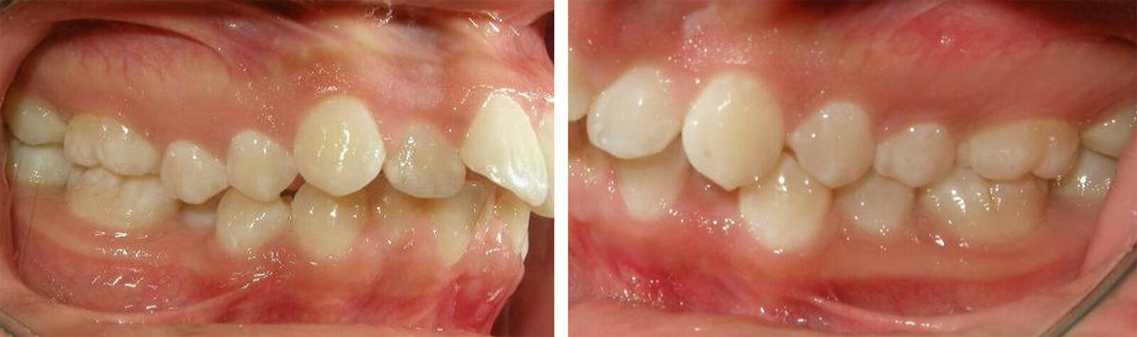 Fig. 11 y 12. Fotografías lateral derecha e izquierda, nótese las relaciones molares y caninas y el overjet. Fuente propia del CESO.
