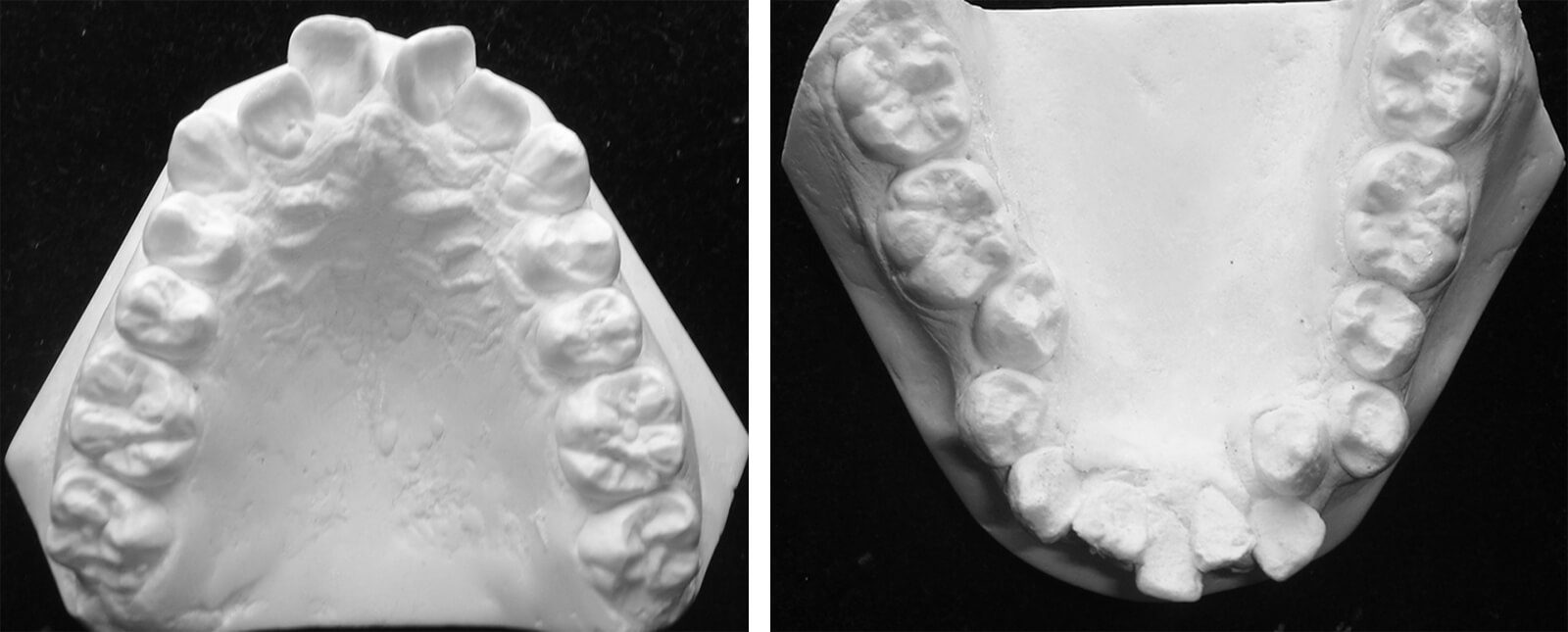 Fig. 13 y 14. Modelos superior e inferior, nótese la forma de la arcada, la falta de espacio, cantidad de piezas presentes. Fuente propia del CESO