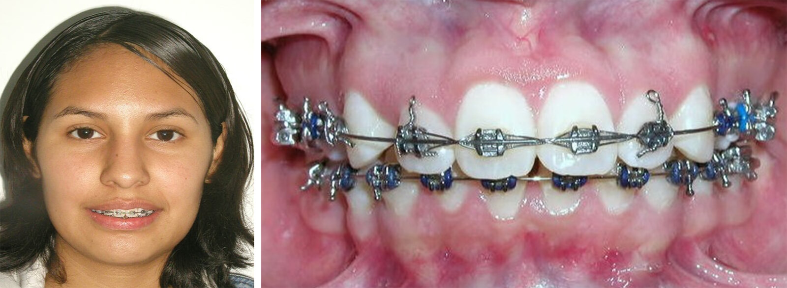 Fig. 15 fotografía de frente en sonrisa, y fig 16. intraoral de frente con la aparatología, la coincidencia de líneas medias y la alineación. Fuente propia del CESO.