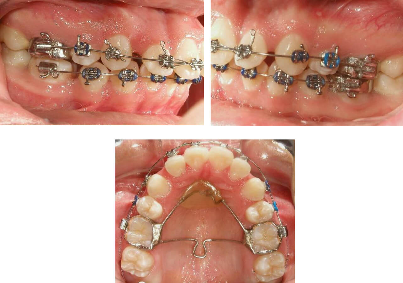 Fig. 17, fotografía lateral intraoral derecha, fig 18 fotografía lateral intraoral izquierda y fig. fotografia 19 vista oclusal superior, notese la distalización de caninos superiores, pérdida de anclaje inferior, anclaje superior tipo transpalance. Fuente propia del CESO.