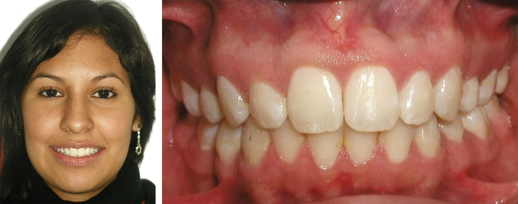 Fig. 20 Fotografía de frente en sonrisa y fig 21 fotografía intraoral de frente, nótese la simetría en la sonrisa y el agradable balance facial. Fuente propia del CESO.