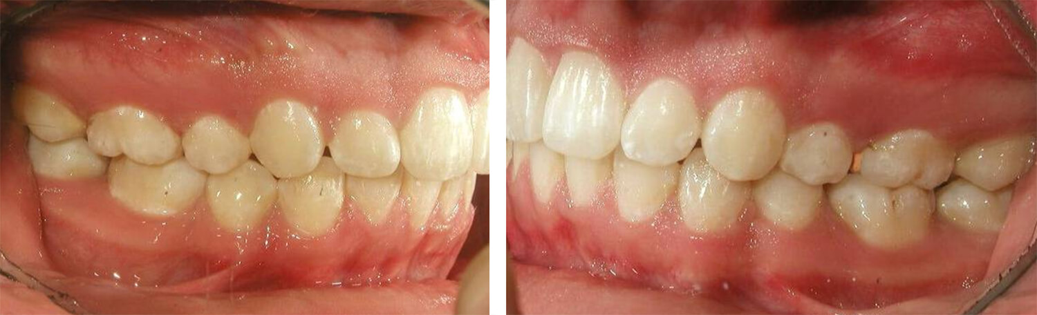 Fig. 22 y 23. Fotografías lateral derecha e izquierda, nótese la clase I molar y canina bilateral. Fuente propia del CESO.