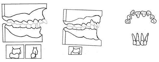 (fig.3) Rojas,g., Brito ,J., Diaz,J. , Soto, S., Alcedo,C., Quirós,O., D´Jurisic, A., fuenmayor,D., Maza,P. Ortiz,M. "Tipo de Maloclusiones Dentales más frecuentes en los pacientes del Diplomado de Ortodoncia Interceptiva de la Universidad Gran Mariscal de Ayacucho 2007-2008." http://www.ortodoncia.ws/publicaciones/2010/art4.asp