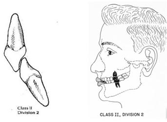 (fig.4) Mordida Profunda http://cchungdentalis.wordpress.com/2012/06/04/bite-better-1-angles-classification/