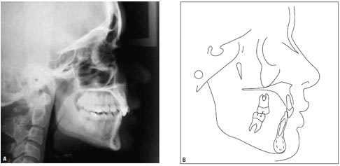 Fig.8 Cefalometría