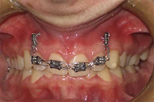 Fig.10 Intrusión con Mini-implantes