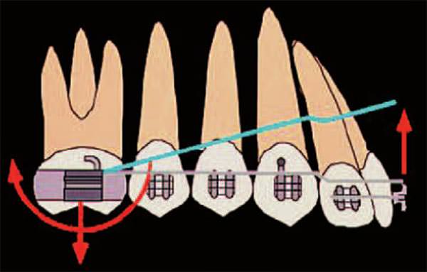 Fig.11 Efectos de reacción al uso de arcos de intrusión Uribe F, Nanda R. Treatment of Class II, Division 2 Malocclusion in Adults: Biomechanical Considerations, Journal of Clinical Orthodontics, volume 37: number 11: pages (599-606) 2003.
