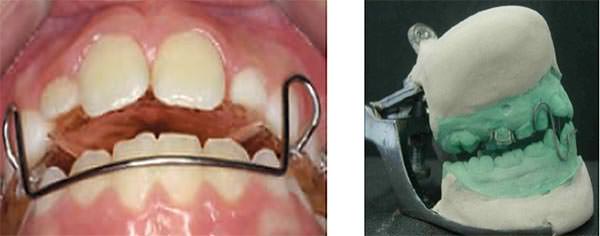 Fig.2 Tomado de Negi KS, Sharma KR. Treatment of pseudo Class III malocclusion by modified Hawleys appliance with inverted labial bow