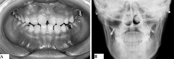 Fig.4 Tomado de Ge YS, Liu J, Chen L, Han JL, Guo XDentofacial effects of two facemask therapies for maxillary protraction