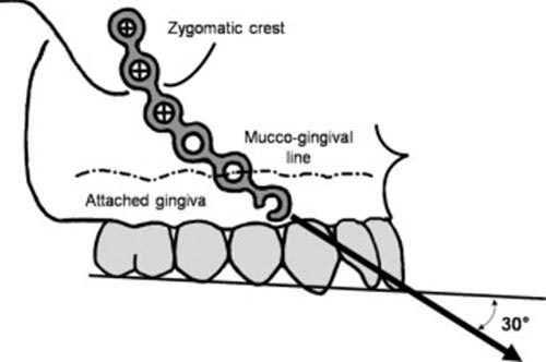 Fig.5 Tomado de Baek S-H, Yang I-H, Kim K-W, Ahn H-W. Treatment of Class III malocclusions using miniplate and mini-implant anchorage