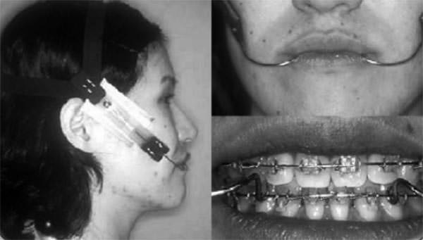 Fig. 6 Tomado de Kuroda Y, Kuroda S, Alexander RG, Tanaka E. Adult Class lll Treatment Using a J-Hook Headgear to the Mandibular Arch.